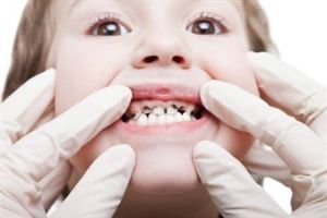 Ci sono molte ragioni per cui i bambini hanno i denti da latte anneriti: