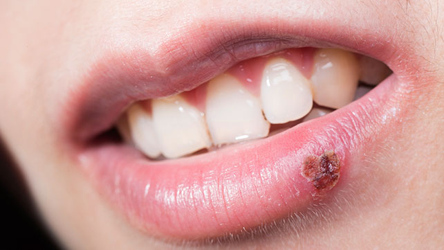 Герпес - это красные, заполненные жидкостью пузырьки, которые образуются возле рта или на других участках лица